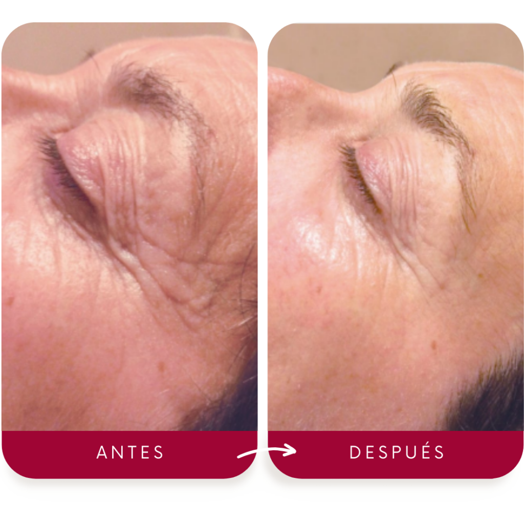 antes-despues-indiba