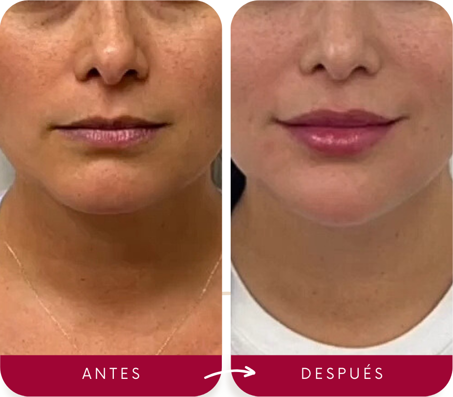 antes-despues-acido-hialuronico