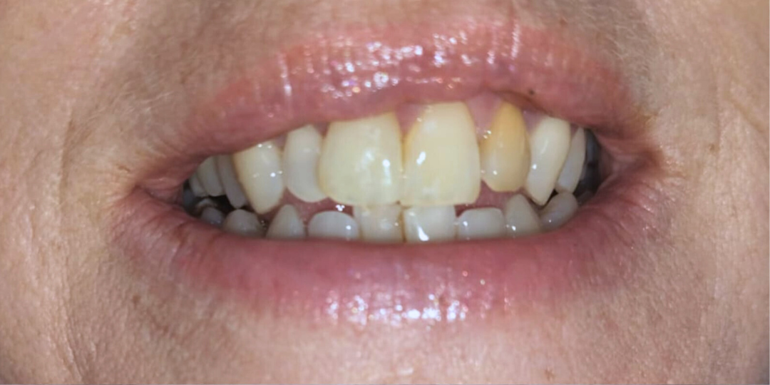 antes_limpieza_dental
