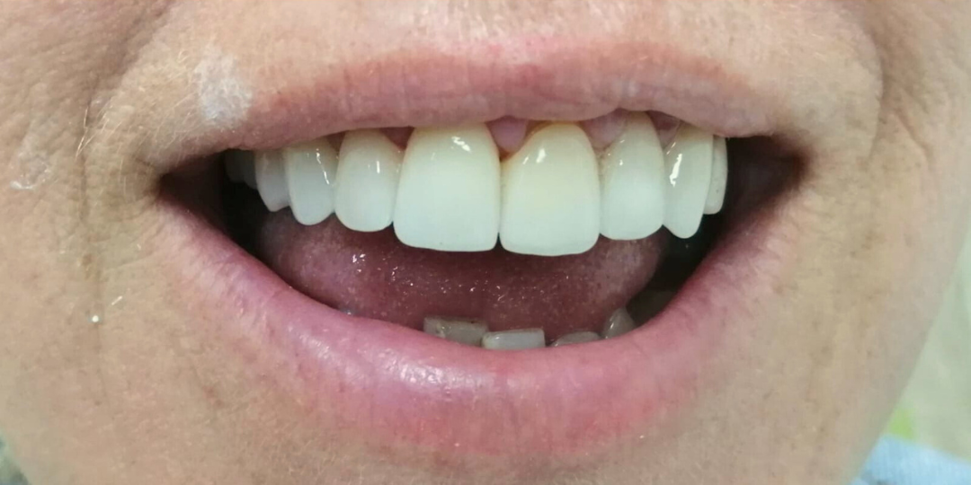 despues_limpieza_dental
