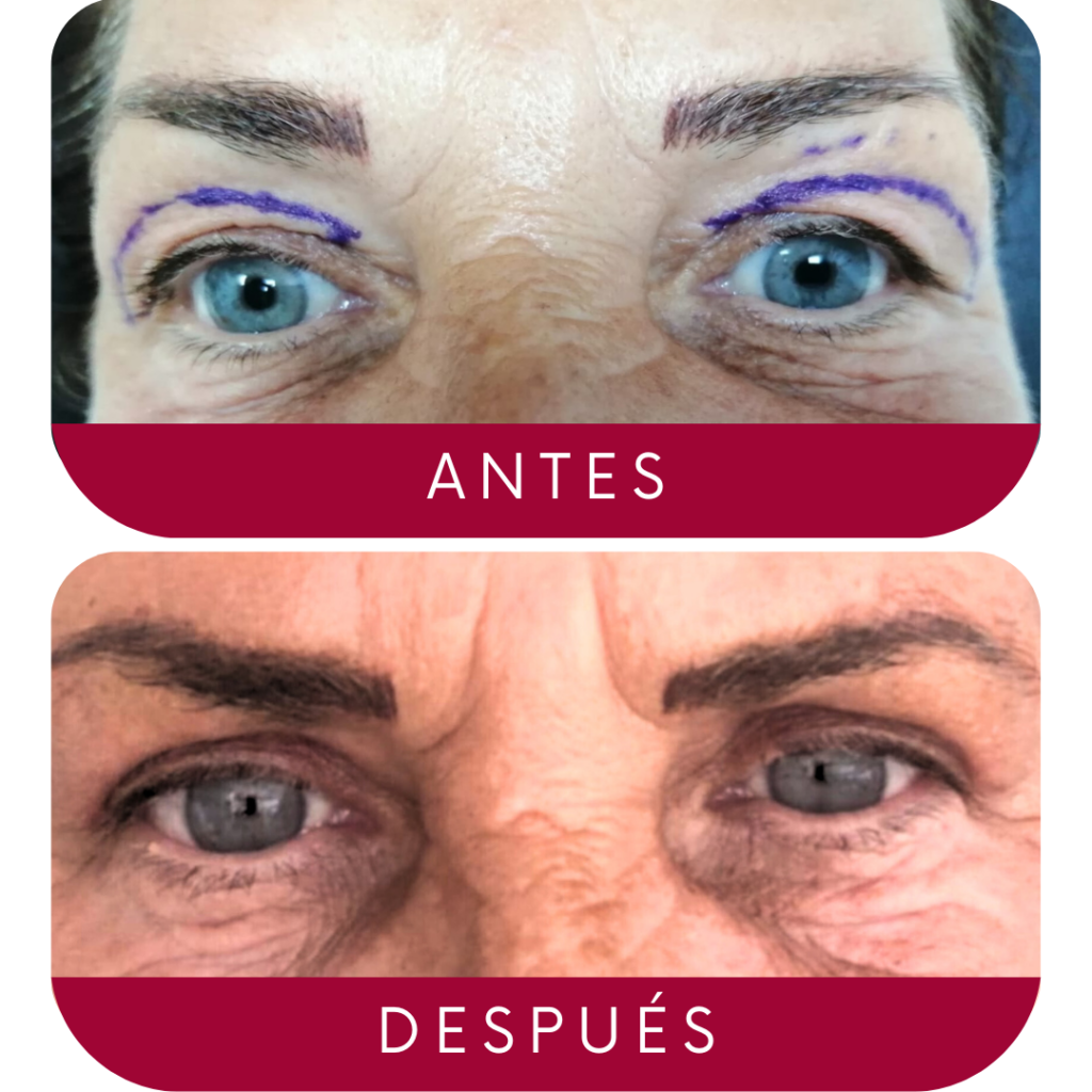 antes-despues-blefaroplastia