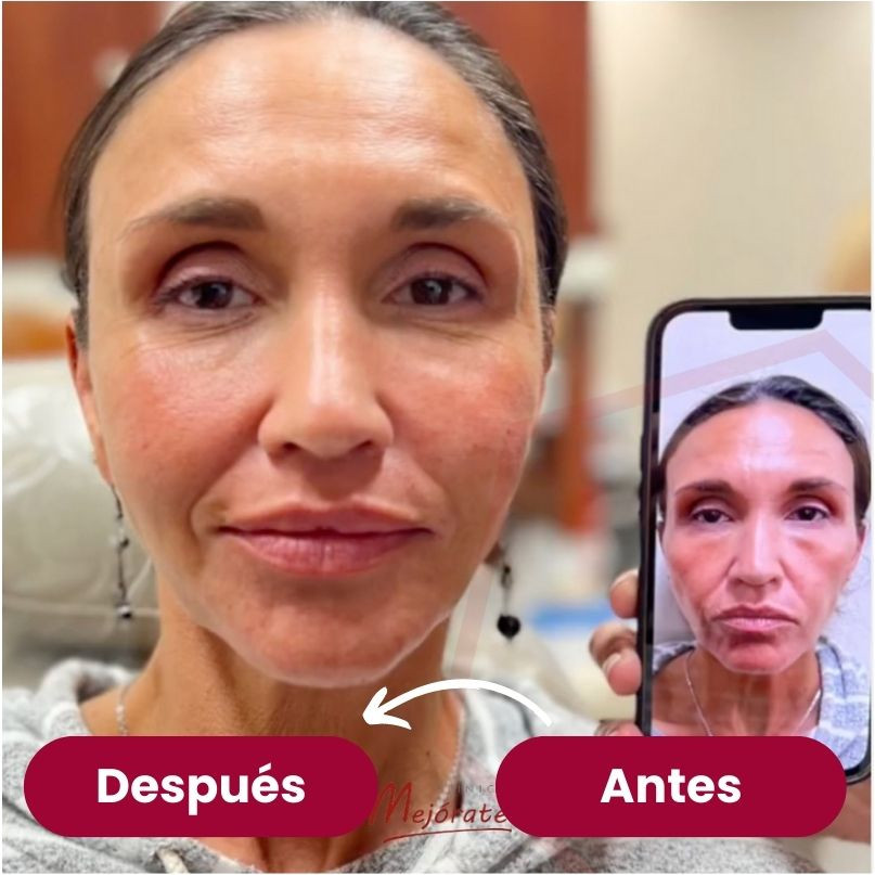 antes_despues_rejuvenecimiento